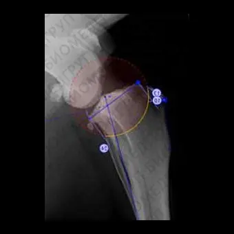Программное обеспечение для ортопедической хирургии