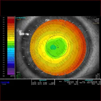 Tomey TMS5 Корнеотопограф