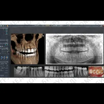 Программное обеспечение для обработки снимков зубов SIDEXIS 4