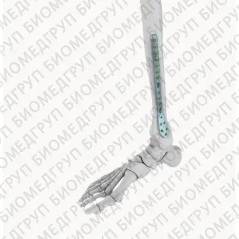 Компрессионная костная пластина большеберцовая кость ELT010